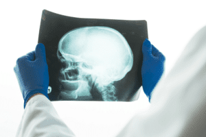 skull fracture x-ray